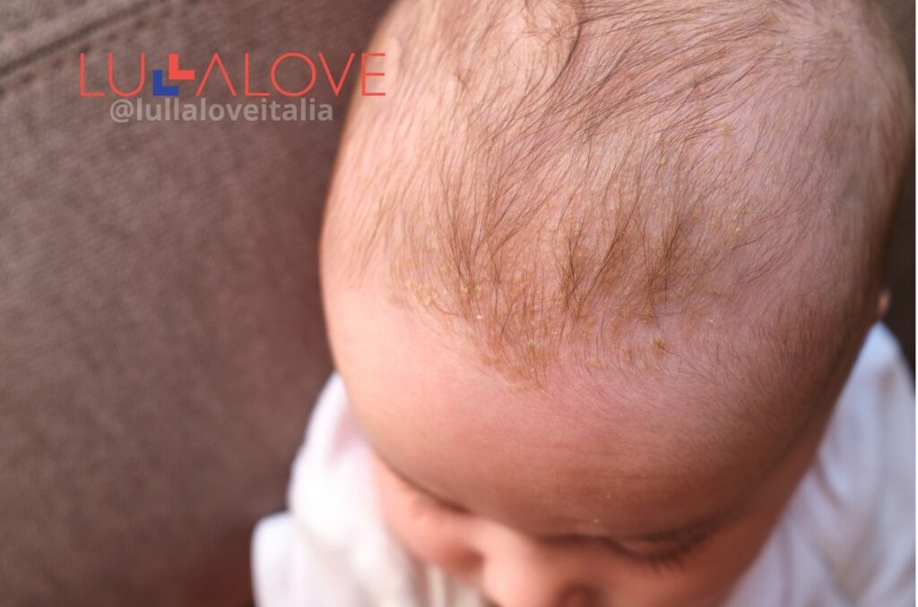 Testa di neonato con crosta lattea, esempio di cura delicata con spazzola naturale